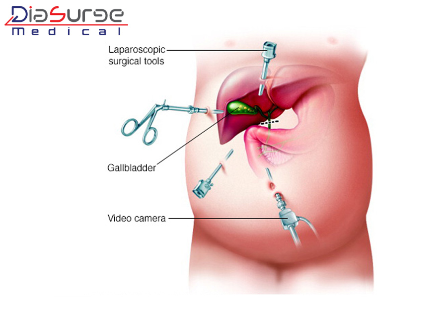 Gallbladder Stones and diagnosis by Endoscopes