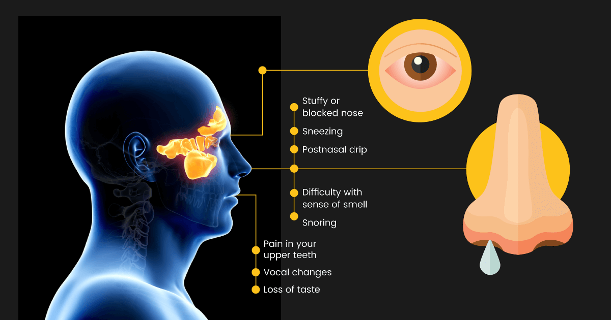 Frequent rhinitis: matter of concern.