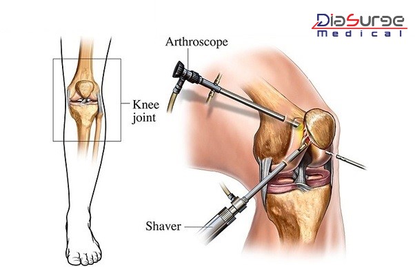 ACL INJURY: THINGS TO KNOW ABOUT