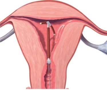 EMBEDDED IUDS: DIAGNOSIS AND REMOVAL OF IUDS