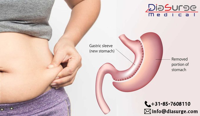 Laparoscopic Adjustable Gastric Banding (LAGB): obesity solution